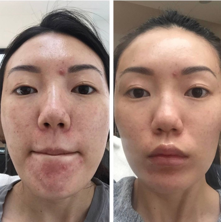 کرم ترمیم کننده و درمان منافذ پوست Cicalfate+ Avèneاصل (ارسال به ضمانت اصل بودن)